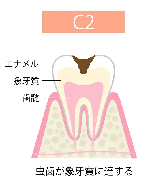 虫歯が象牙質に達する